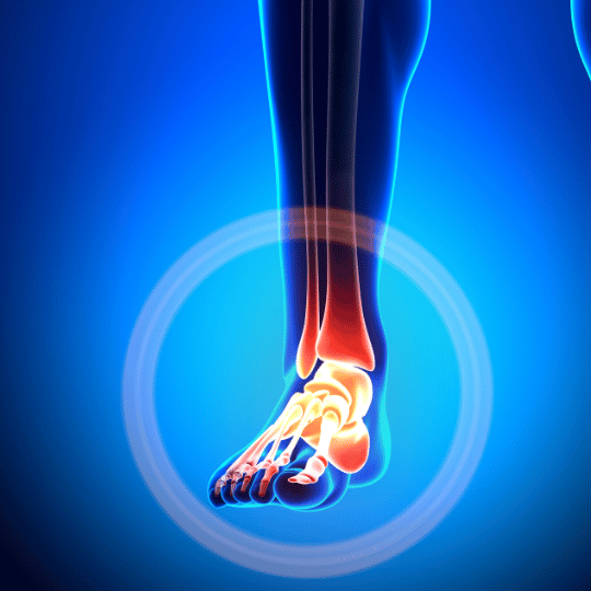 Lättäjalka - Hoito, syyt ja yleisimmät väärinkäsitykset