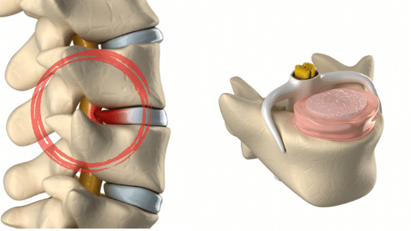 Selkäkipu - Kipujen ennaltaehkäisy ymmärtämällä selän anatomiaa