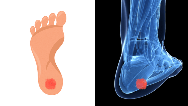 Paljasjalkakenkä kokemuksia työkenkinä - luupiikki kantapäässä